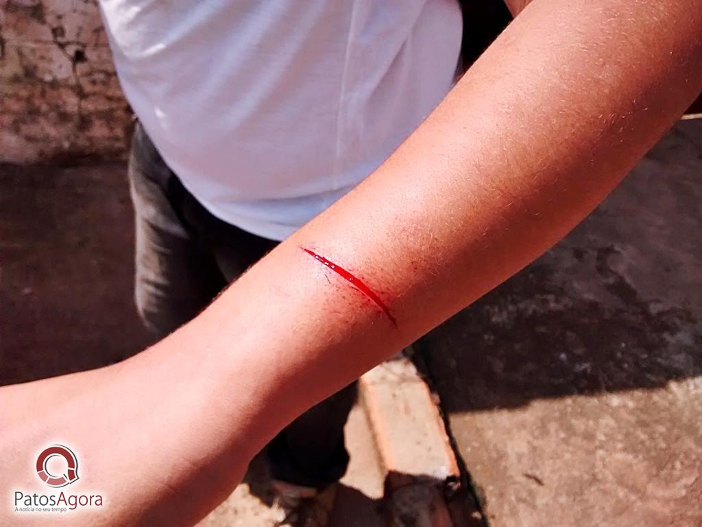 Brincadeira entre três alunos termina com o braço cortado | Patos Agora - A notícia no seu tempo - https://patosagora.net