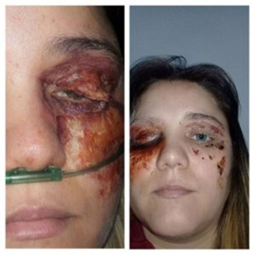 Mulher é presa em São Gotardo após enganar à todos com suposta infecção no rosto
